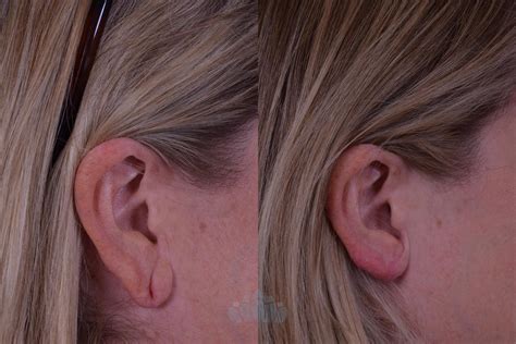 Earlobe Repair Before and After Pictures Case 58 | Charlotte, NC | Dilworth Facial Plastic Surgery