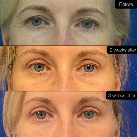 Washington DC Lower Blepharoplasty/ Under-Eye Bag Removal Before and After Pictures | Tysons Corner