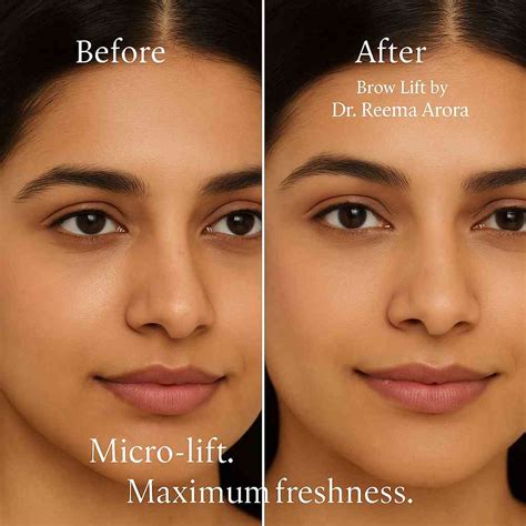 Eyebrow Lift in Delhi | Non-Surgical Brow Lift Cost, Results & Doctor-Led Care