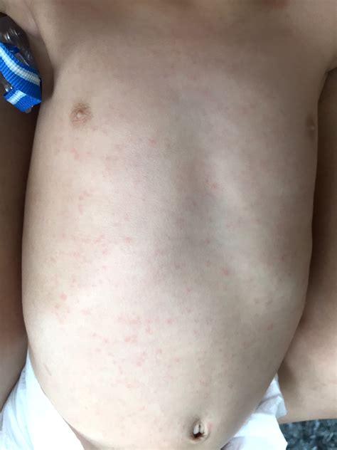The Devil is Roseola and How I Survived It - Jo Lauren