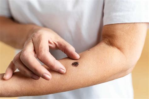 Scaly Patches on Face, Hands & Arms: Causes & When to See a Doctor