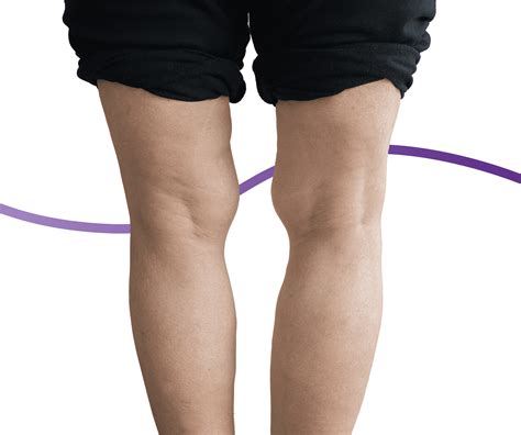 Knocked Knees (Genu Valgum): Causes, Symptoms & Treatment | The Feet ...