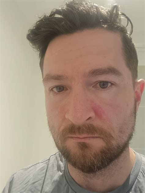 Cpap Mask Making Marks On Face at Rebecca Hart blog