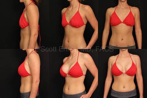 Breast Augmentation Transaxillary Breast Augmentation: Pros & Cons