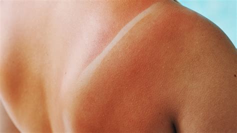How to Treat a Sunburn: Tips for Pain, Peeling and More - The New York ...