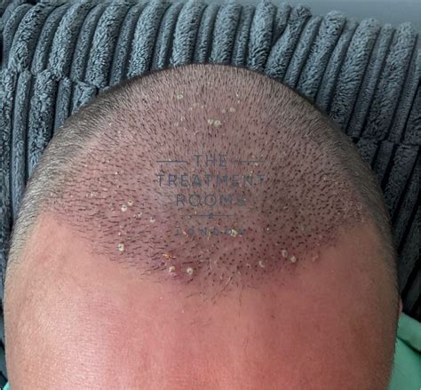 What is Folliculitis? Can it cause hair loss? - Treatment Rooms London