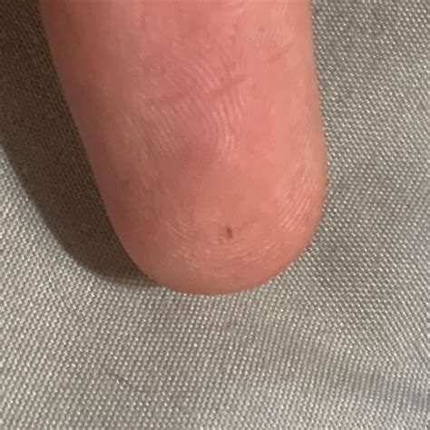 Tiny White Bugs On Skin _ Types of Red Bugs (Including Tiny Bugs ...