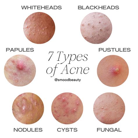 Acne 101: The Different Types of Acne and How to Treat Them