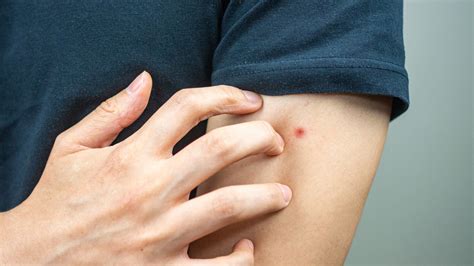 ¿Cómo reconocer la picadura de una chinche?