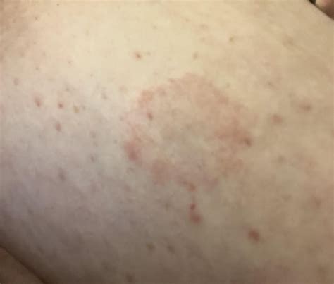 Spot on breast : r/breast_cancer