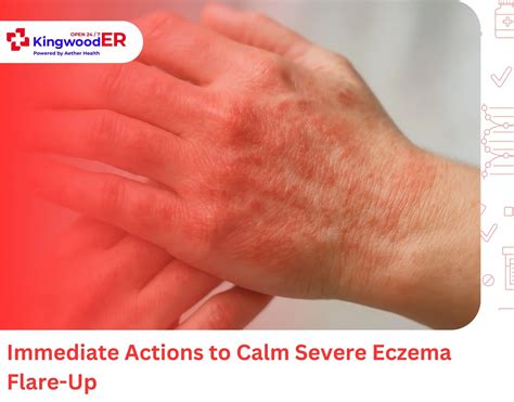 How To Treat Severe Eczema Flare-Up