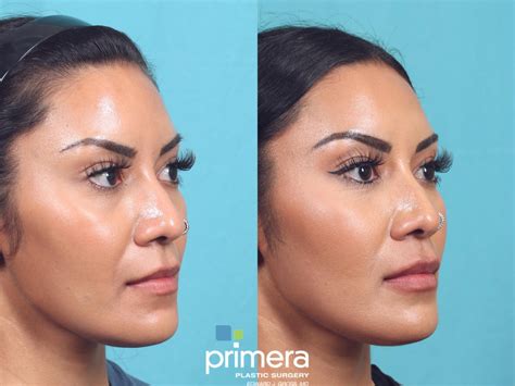 Should I Get Lip Injections or Lip Augmentation Surgery? – Primera Plastic Surgery