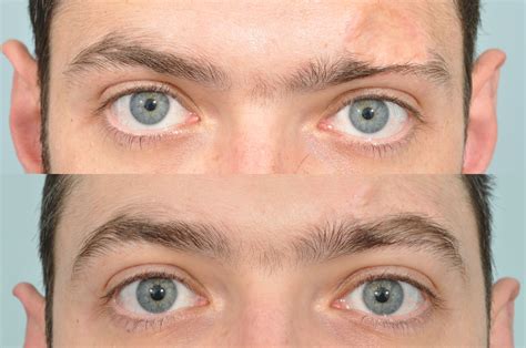 Eyebrow Transplantation is a surgical procedure intended to permanently ...