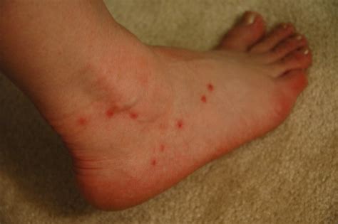 Pictures of Gnat & Insect Bites: How to ID them| Welzo – welzo