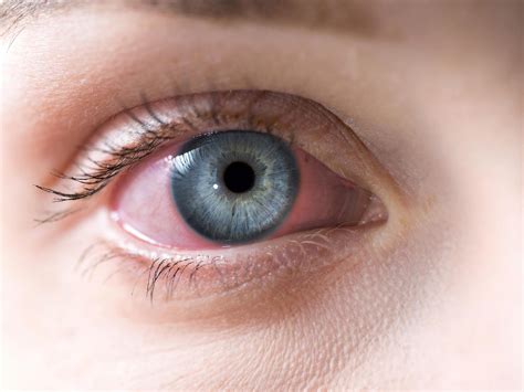 Pink Eye (Conjunctivitis) | University of Utah Health