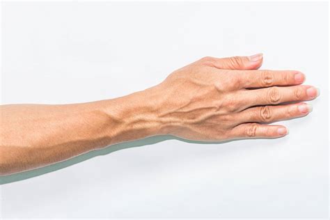 Why do I have varicose veins in my arm?