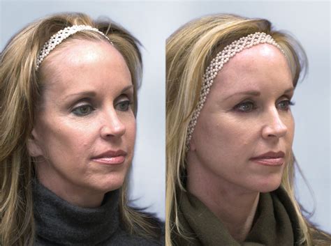 Sculptra Before and After 3 | Robinson FPS