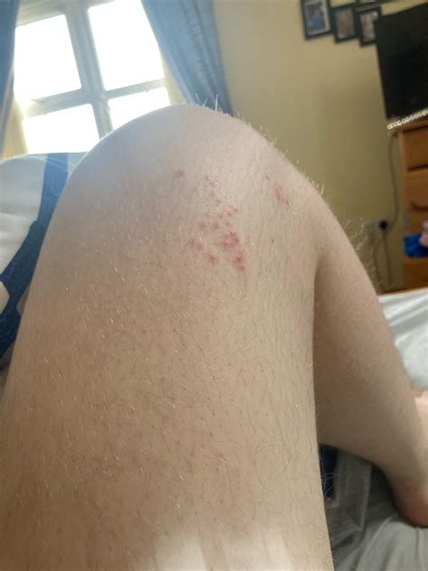 Leg has a burning sensation when touched, rash broke out today?? Been ...
