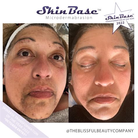 Microdermabrasion vs Microneedling