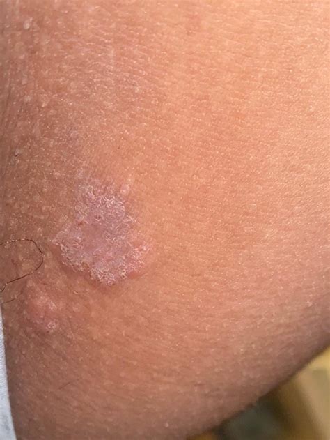 What is this? it’s itchy and on inner thigh : r/Dermatology