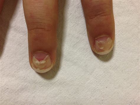 Onychomadesis—A Late Complication of Hand-Foot-Mouth Disease - The ...