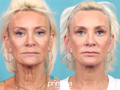 Neck Lift Before and After Pictures Case 952 | Orlando, Winter Park & Tampa, Florida | Primera ...