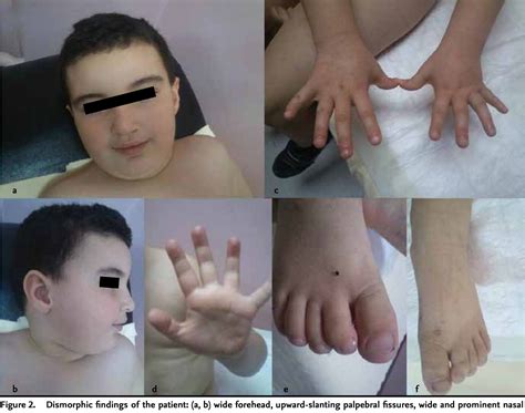 Xxxy Syndrome Endocrine Function In A 48,XXYY Adult With Type 2