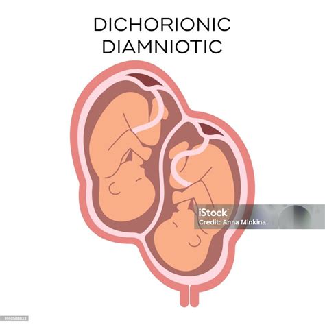 Diamniotic And Dichorionic Twins