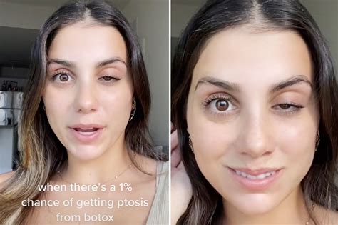 Best Eye Drops For Droopy Eyelid After Botox at Bridget Pardo blog