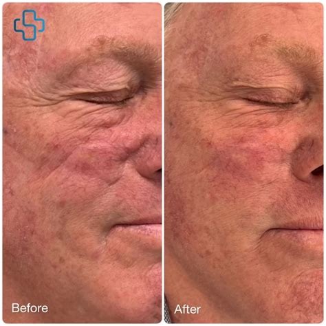 Rosacea Laser Treatment | Elite Medical Centre