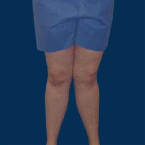 Knock Knee: Causes, Symptoms, Diagnosis and Treatment