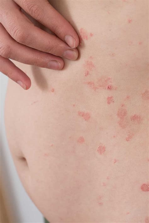 Pregnancy Dermatoses - DermAlly | Specialist Skin Clinic