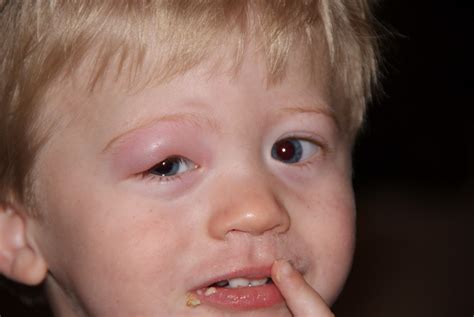 Eye Swelling Toddler at Jill Baker blog