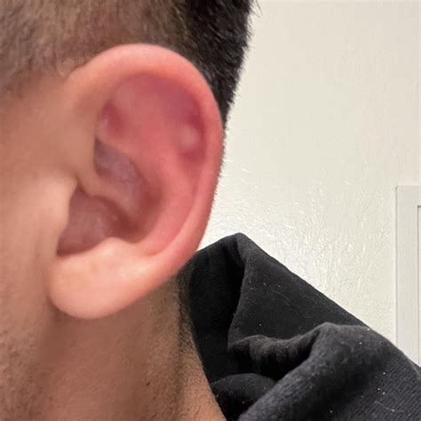 Hard lump on my ear cartilage : r/DermatologyQuestions