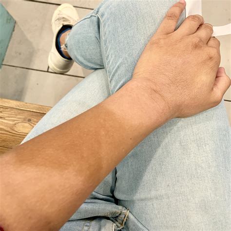 Any advice for treating post inflammatory hypopigmentation? Doesn’t get red or inflamed anymore ...