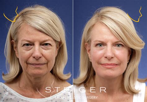 Facelift Before and After Photos | Deep Plane Facelift | Facelift before and after, Facelift ...