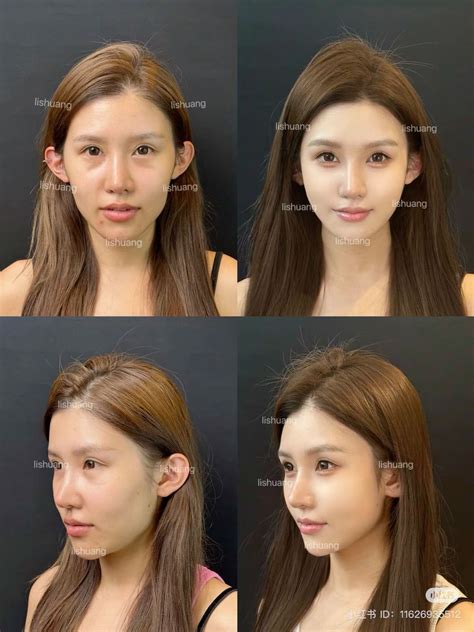 Pin by pupae lalalove on surgery in 2025 | Types of plastic surgery, Facial plastic surgery ...