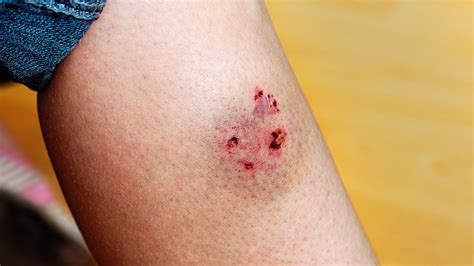 What Should You Do If A Dog Bites You? Tips For When to Get Care - GoodRx