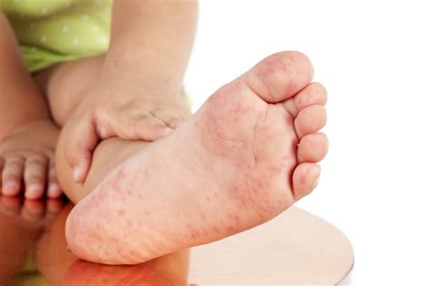 Hand, Foot And Mouth Disease ( HFMD ) – Health Insure Savvy