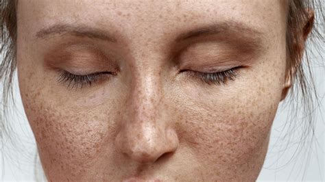 What are freckles Causes, Types & Treatment Options