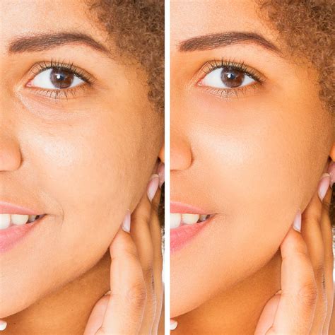 Juvéderm Skinvive - Injectable Filler - Santa Rosa and Healdsburg