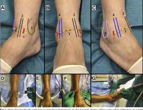 Figure 1 from Fibular Intra-articular Resection During Arthroscopic ...