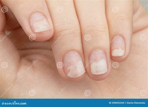 Fingernails with Onycholysis after Removing Gel Polish. Womans Hands ...