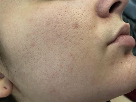 Large Skin Pores