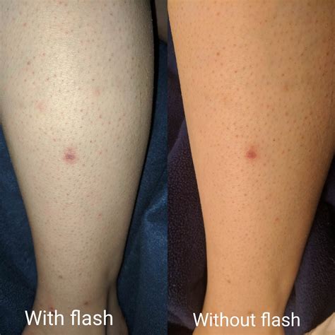 ingrown hair scars legs - Dia Greathouse