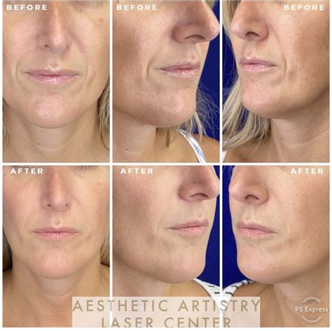 Injectables Archives - Aesthetic Artistry Laser Centers - AALC