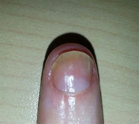 Nail Psoriasis Vicks at Albert Hoopes blog