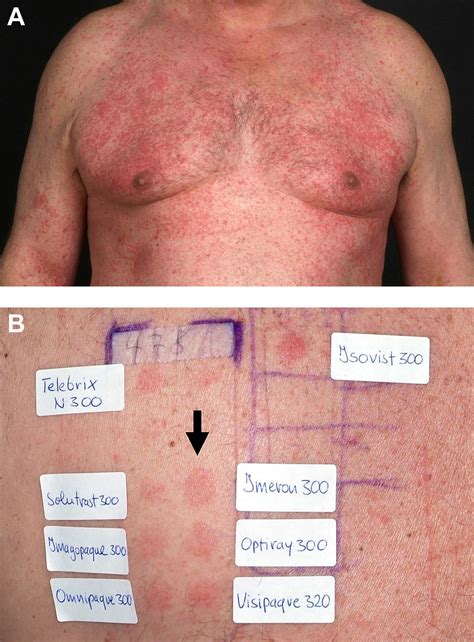 Rash From Cat Scan at Joe Tepper blog