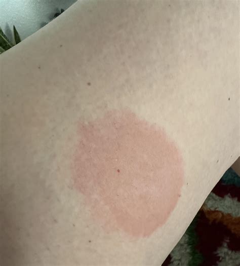 These injection site welts! : r/Zepbound