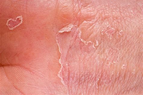 Exploring Various Eczema Types: Understanding the Different Classifications and Symptoms